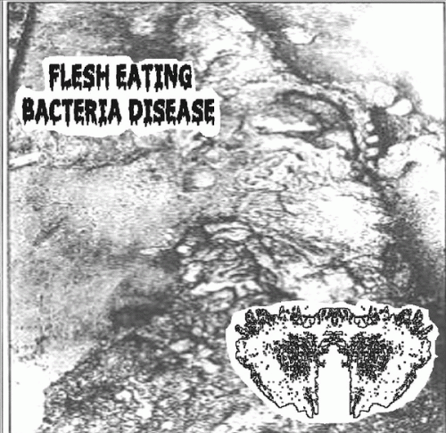 Carcinomas Of Unknown Primary Origin : Flesh Eating Bacteria Disease - Carcinomas of Unknown Primary Origin